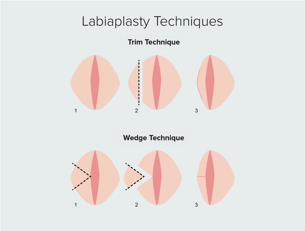تکنیک‌های لابیاپلاستی